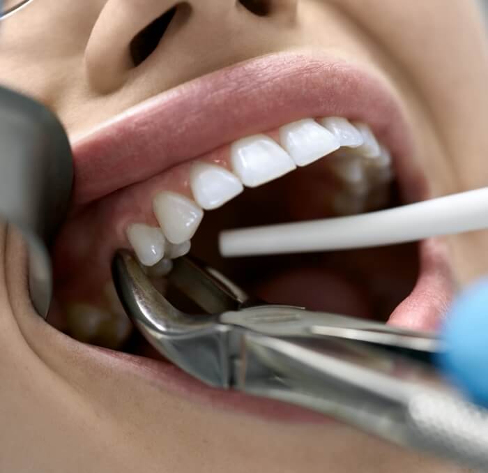 Closeup of tooth extraction procedure