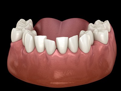 Illustration of a crowded teeth