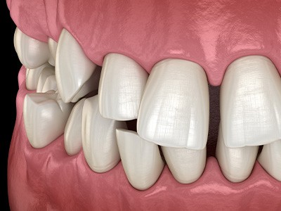 Illustration of gapped teeth