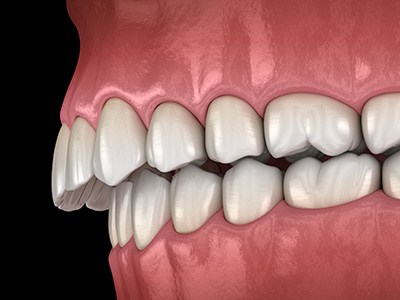 Illustration of an overbite