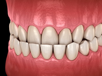 Illustration of an underbite