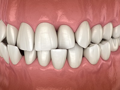 Illustration of a crossbite