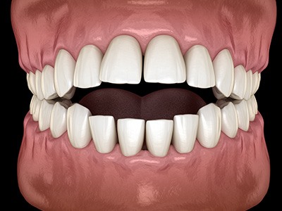 Illustration of an open bite