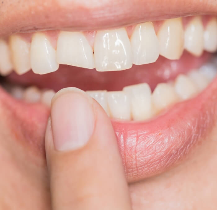 Closeup of smile with broken tooth before dental bonding