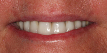 Closeup of healthy smile after dental treatment