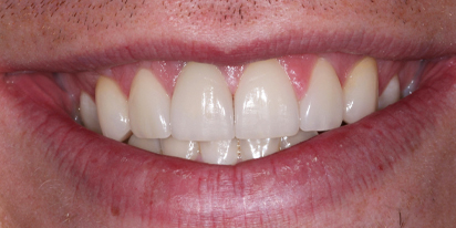 Closeup of smile after treatment for gum tissue recession