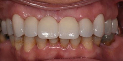 Closeup of smile with a new dental restoration