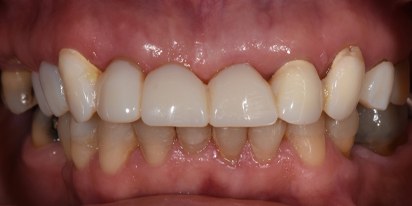 Closeup of smile with damaged dental restoration