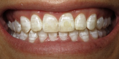 Closeup of healthy white smile after dental treatment for discoloration