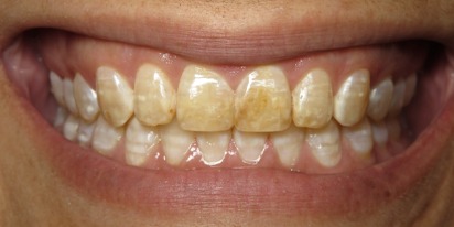 Closeup of smile with severe discoloration