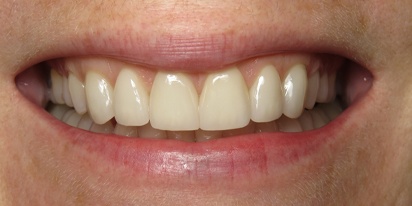 Closeup of perfected smile after treatment for gummy appearance