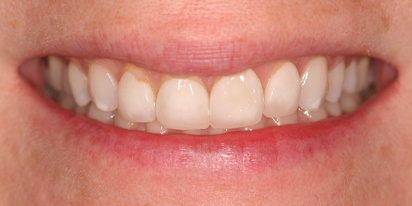 Closeup of gummy smile before cosmetic dentistry