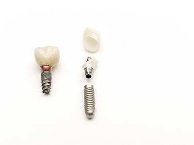 Dental implant parts each have their own separate prices