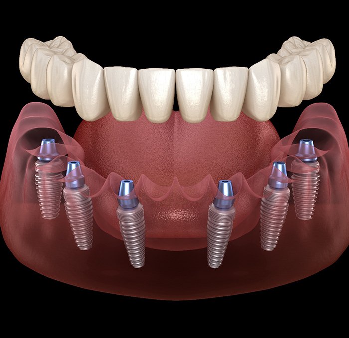 Illustration of implant dentures