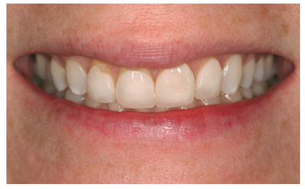 Closeup of flawless smile after cosmetic dental treatment in Buda