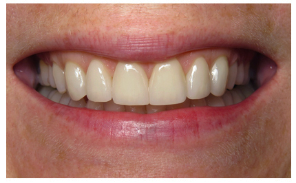 Closeup of imperfect teeth before cosmetic dental treatment in Buda