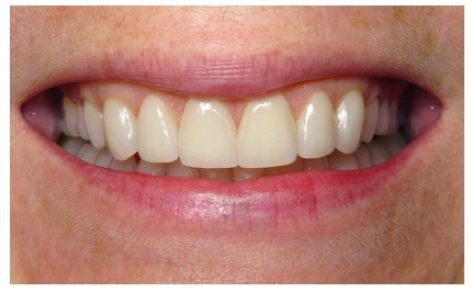 Closeup of imperfect teeth before cosmetic dental treatment in Buda