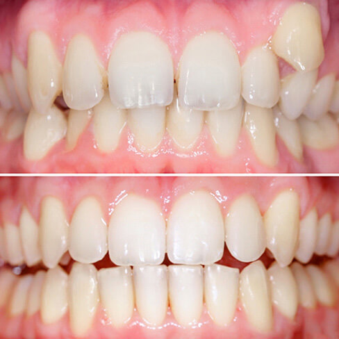 before and after orthodontics