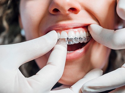 Dentist putting clear aligner on patient