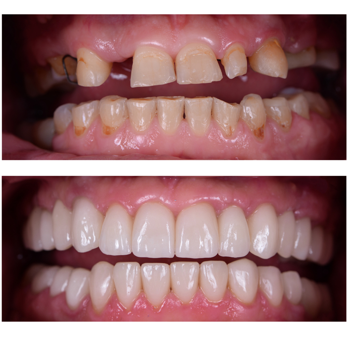 Closeup of smile before and after full mouth reconstruction