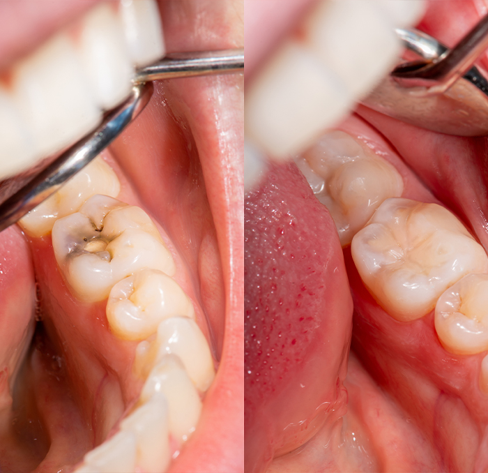 Closeup of smile before and after tooth colored filling treatment
