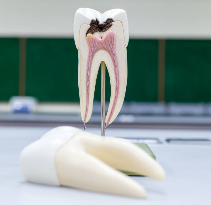 Model of the inside of a damaged tooth before root canal treatment