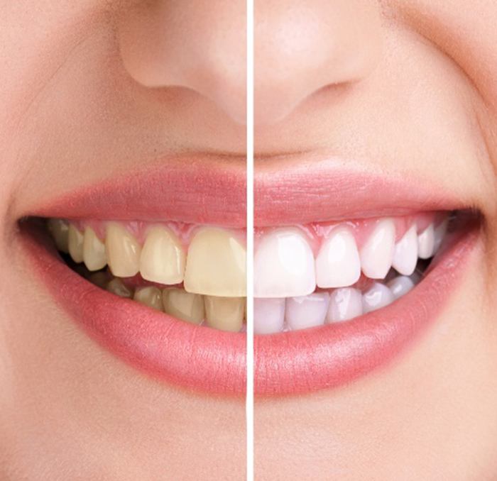Before and after image of teeth whitening in Buda