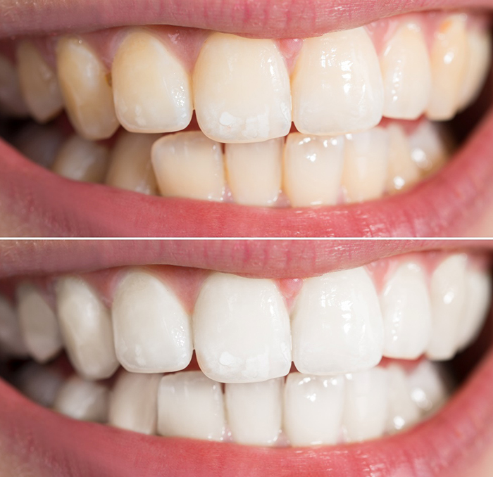 Before and after of a whitening treatment
