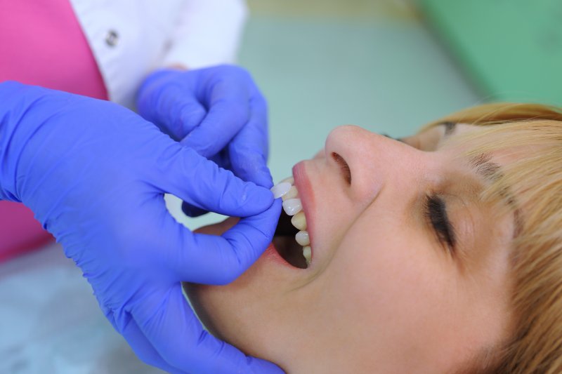 A dentist placing porcelain dental veneers